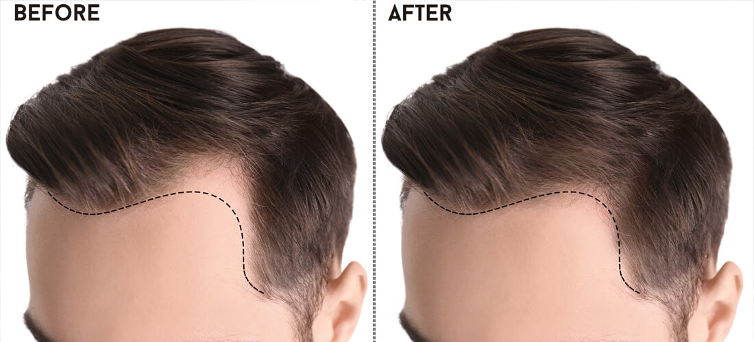 Revitalizing Strands: Navigating the Landscape of Hair Transplants in Pakistan