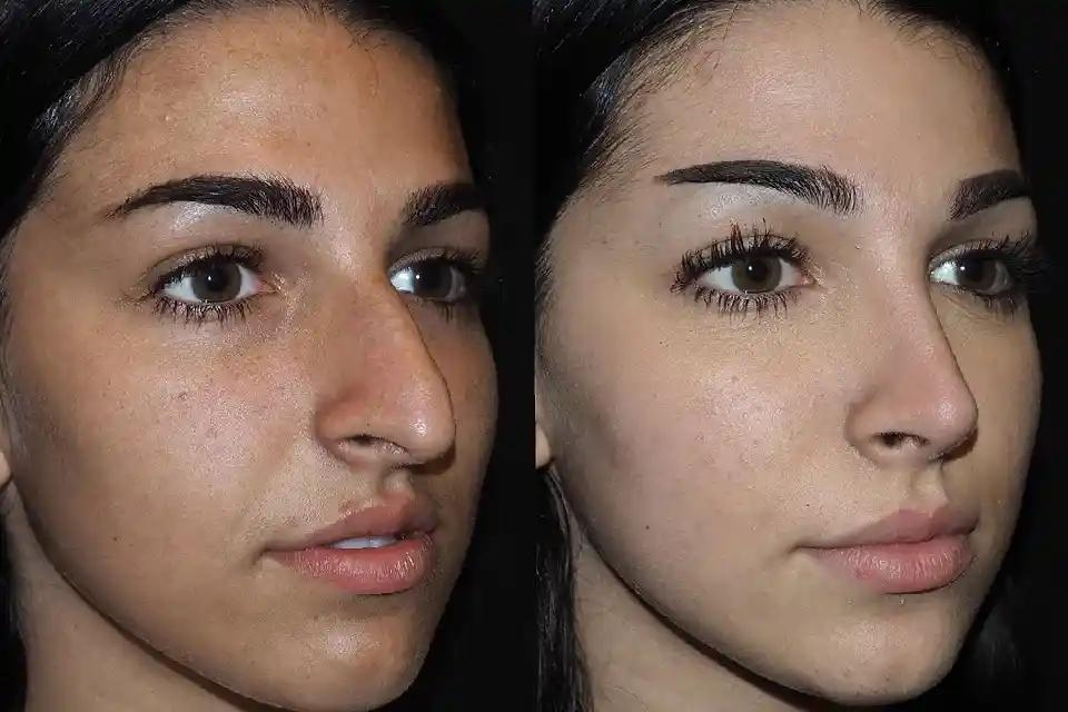 Embracing Excellence: Understanding Rhinoplasty in Dubai